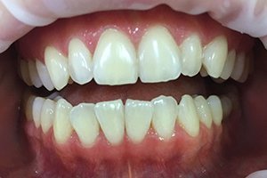 Отбеливание зубов оттенка А2