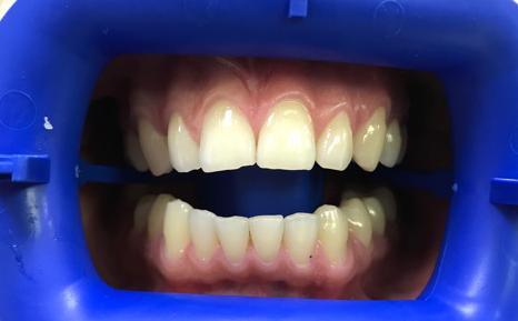 Отбеливание зубов по технологии Zoom White Speed