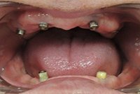 Балочное протезирование на имплантах при частичной адентии