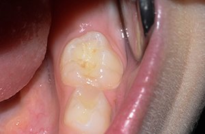 Пломбирование детского зуба при лечении кариеса