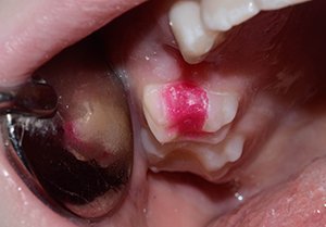 Установка цветной пломбы при лечении кариеса у ребенка