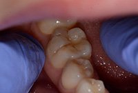 Лечение кариеса жевательного зуба пломбировочным материалом