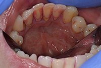 Удаление коричневого зубного налета