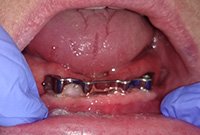 Съемное протезирование балочной конструкцией