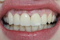 Протезирование резцов верхней челюсти коронками