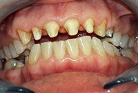 Установка керамических коронок на каркасе из диоксида циркония