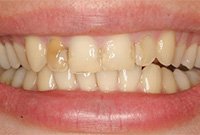 Косметический дефект бокового резца — реставрация