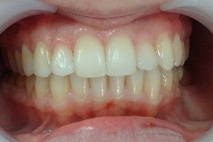 Исправление прикуса брекетам Damon Q и Damon Clear