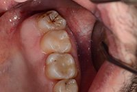 Лечение кариеса моляра на нижней челюсти