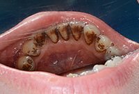 Снятие твердых зубных отложений ультразвуком