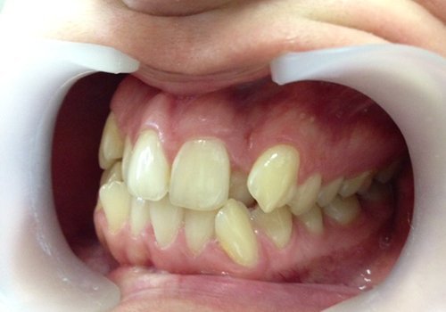 Выравнивание зубов комбинированными брекетами Ormco