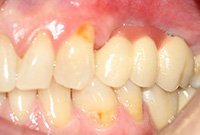 Восстановление зубов коронками на имплантах