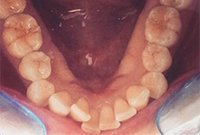 Лечение скученности зубов брекетами