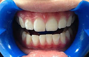 Профессиональное Beyond-отбеливание зубов