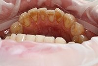 Чистка зубов пескоструйным аппаратом Эйр Флоу