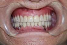 Несъемное протезирование премоляров и моляров