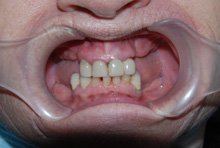 Несъемное протезирование премоляров и моляров