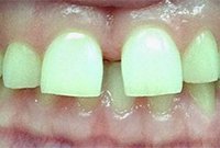 Лечение диастемы керамической брекет-системой