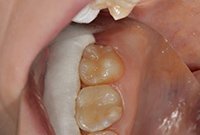 Установка пломбы при лечении кариеса моляра