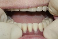 Протезирование нижней челюсти покрывным протезом