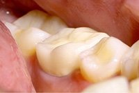 Восстановление жевательного зуба металлокерамической коронкой