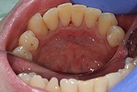 Удаление коричневого зубного налета