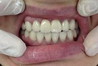 Установка протезов с телескопическими коронками