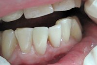 Устранение скола на переднем зубе