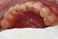 Чистка зубов пескоструйным аппаратом Эйр Флоу