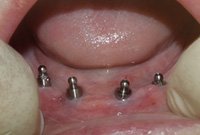 Протезирование нижней челюсти покрывным протезом