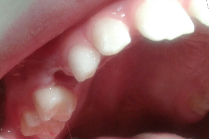 Лечение кариеса молочного зуба после удаления соседнего