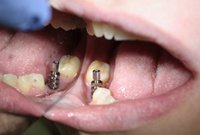 Протезирование моляров зубными коронками на имплантах