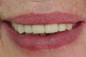 Установка зубных коронок на культевых вкладках