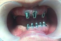 Установка протезов с телескопическими коронками