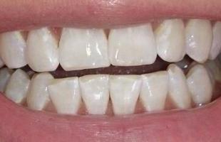 Профессиональное отбеливание зубов по технологии ZOOM