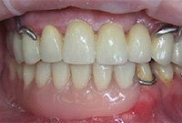 Протезирование металлокерамикой и установка бюгельного протеза