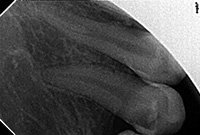 Хирургическое лечение пульпита зуба