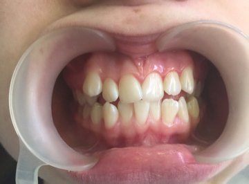 Исправление скученности зубов брекетами Damon