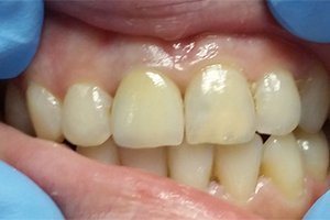 Восстановление верхнего центрального резца коронкой