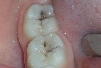 Реставрация жевательных зубов материалом Filtek Ultimate