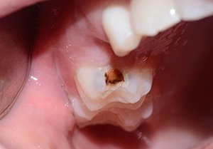 Установка цветной пломбы при лечении кариеса у ребенка