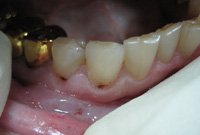 Лечение кариеса корня зуба