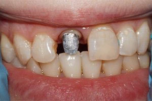 Восстановление верхнего центрального резца коронкой