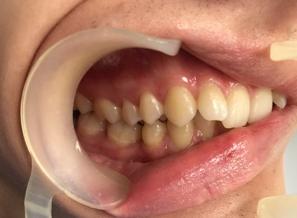 Лечение металлической брекет-системой Damon Q