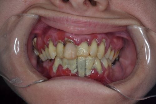 Комплексная реконструкция улыбки