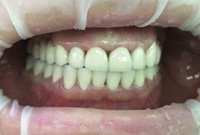 Металлокерамические коронки при патологической стираемости зубов