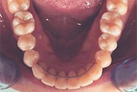 Лечение скученности зубов брекетами