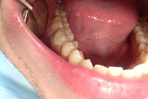 Протезирование моляра циркониевой коронкой