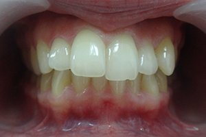 Исправление прикуса брекетам Damon Q и Damon Clear