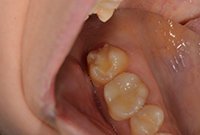 Установка пломбы при лечении кариеса моляра